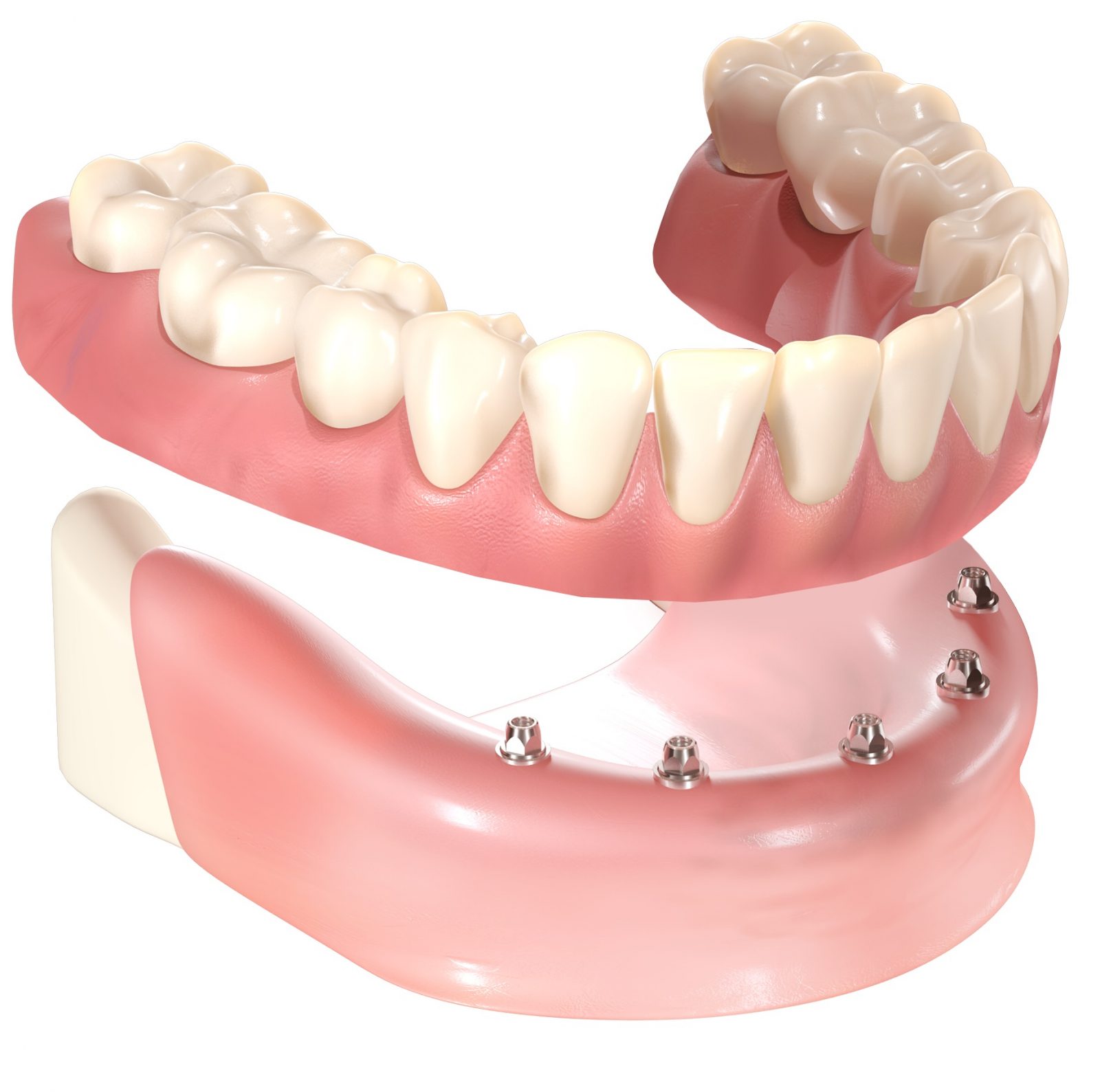 Implant Retained Dentures HQ Dental, Leeds, UK