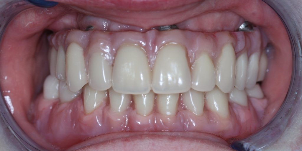 HQ Dental Lab Services All on 4