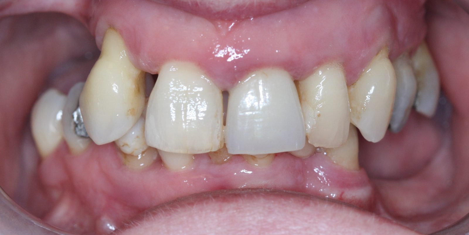 HQ Dental Lab Services All on 4