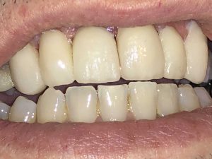 emax dental crown