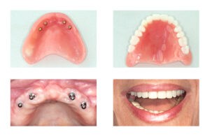Implant Retained Dentures - Upper