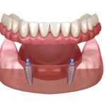 Implants retained dentures