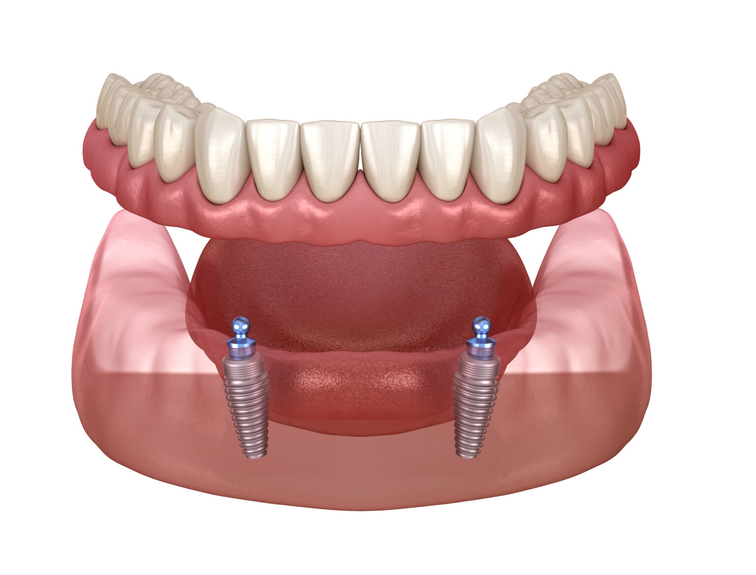 Implant Retained Dentures HQ Dental, Leeds, UK