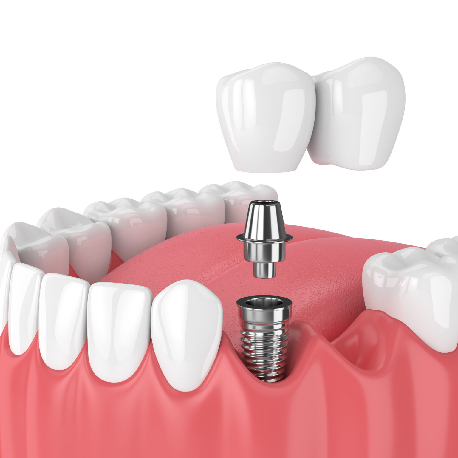 Single Tooth Implants Leeds HQ Dental