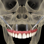 Zygomatic Implants