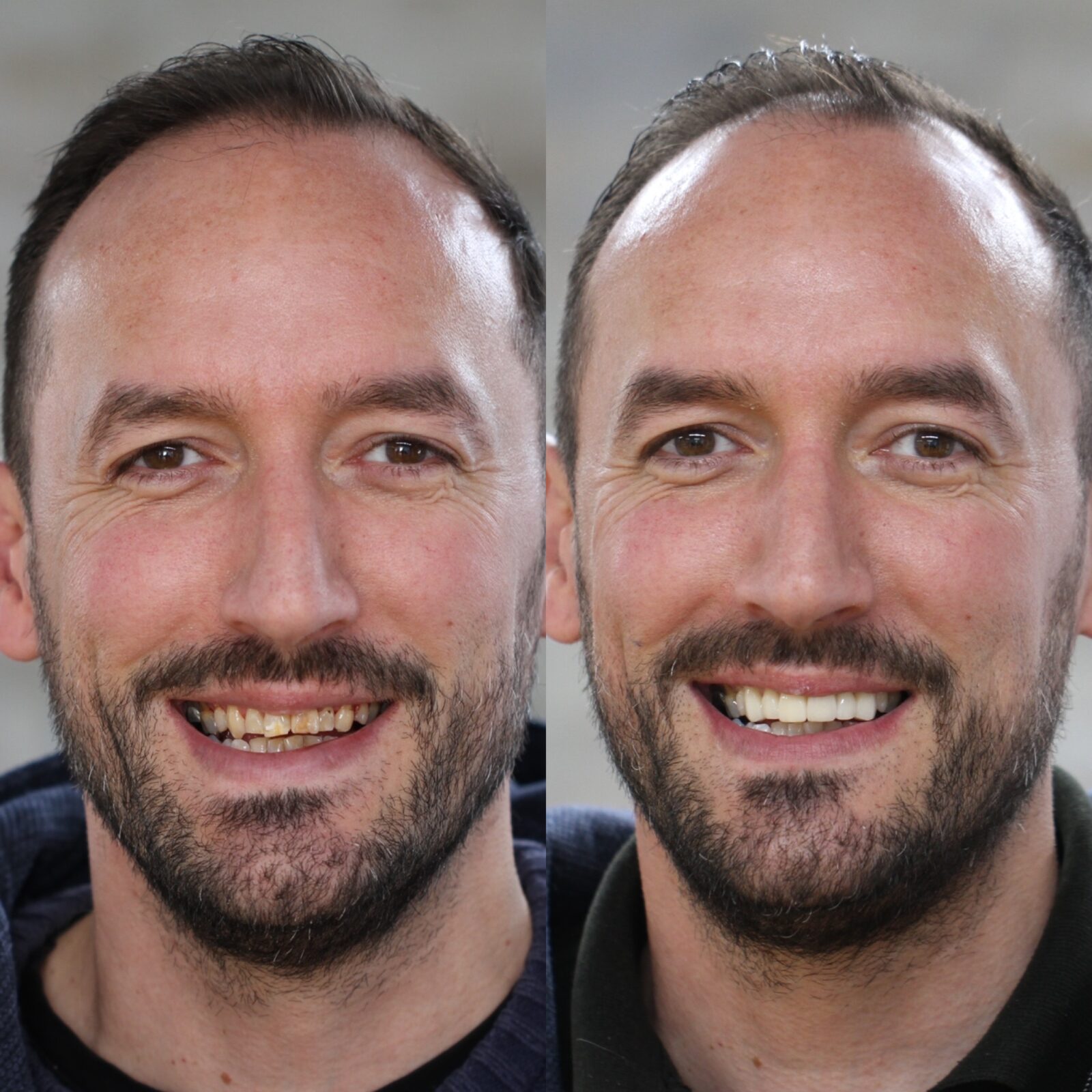 Veneers Leeds Porcelain, Emax & No Prep Veneers HQ Dental